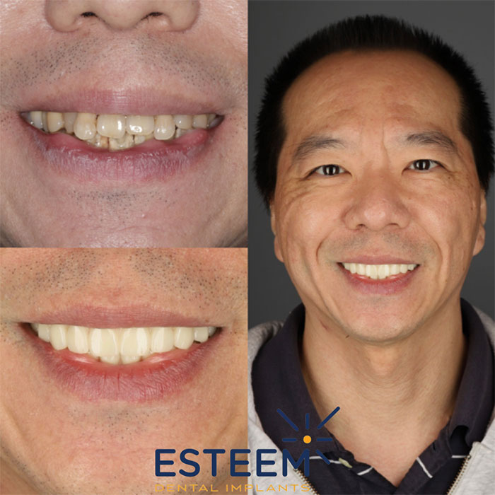 esteem before and after case