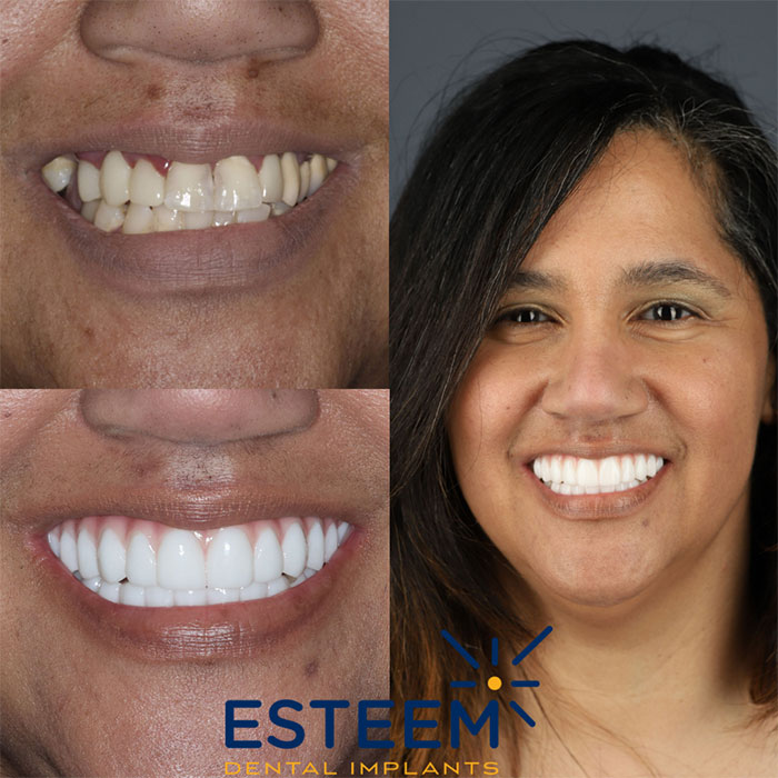esteem before and after case